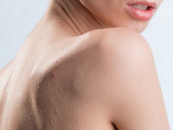 Home Remedies For Back Acne