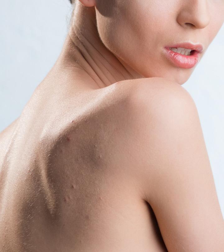 Acne in between breast – Back/Body/Neck acne –  Forum