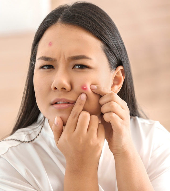 पिम्पल/मुंहासे हटाने के कुछ आसान तरीके – How to Remove Pimples in Hindi