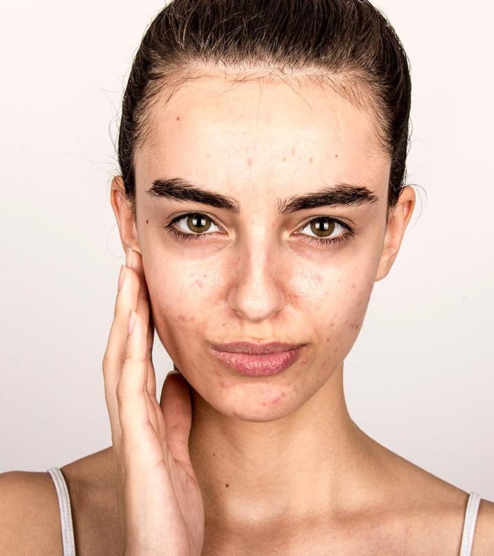 Face mapping your acne and what it means on your face revealed