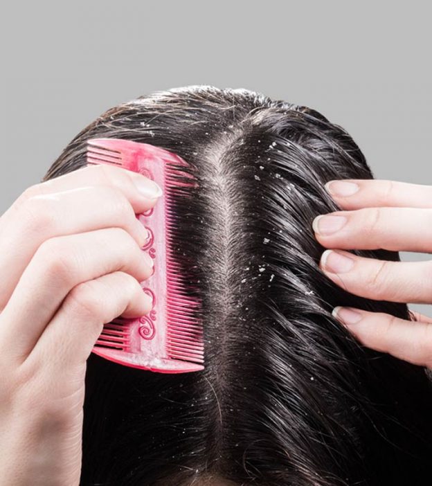 बालों से रूसी (डैंड्रफ) हटाने के उपाय – Dandruff Treatment at Home in Hindi