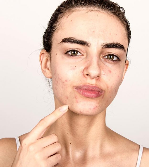 Hormonal Acne: Causes, How To Treat It, And Foods To Avoid