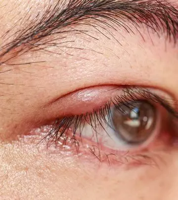 Home Remedies To Treat Pimple On The Eyelid