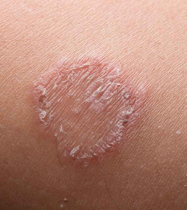 दाद के कारण, लक्षण, इलाज और घरेलू उपाय – Home Remedies For Ringworm in Hindi