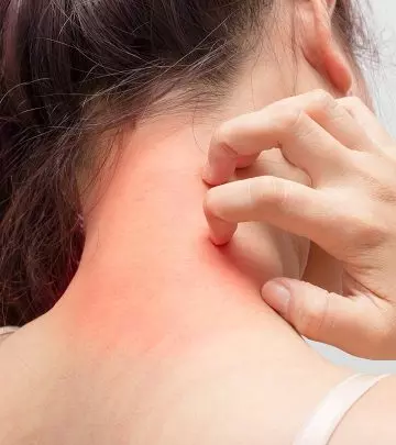 एक्जिमा के कारण, लक्षण और घरेलू उपाय – Eczema Symptoms and Home Remedies in Hindi
