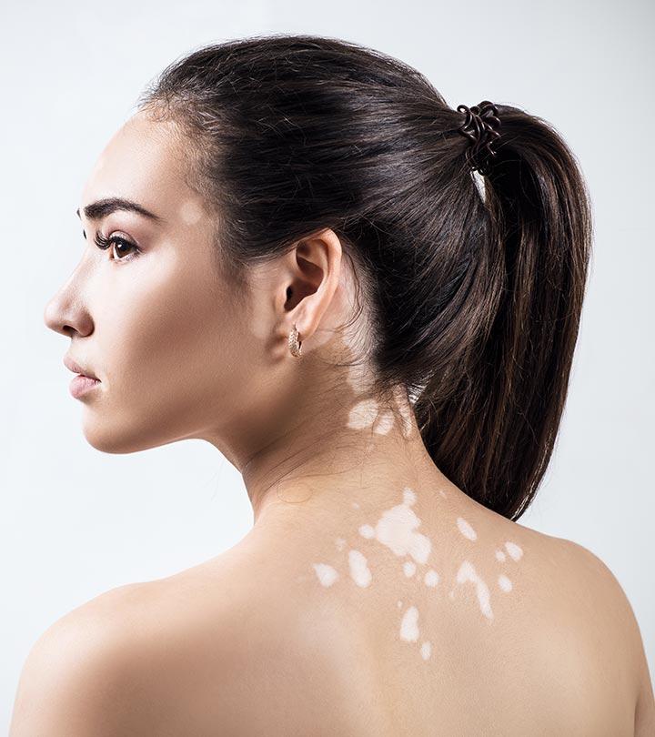 सफेद दाग के कारण और हटाने के घरेलू उपाय – White Spots (Vitiligo) Home Remedies in Hindi