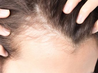 गंजेपन के कारण, लक्षण और घरेलू इलाज – 12 Home Remedies for Baldness in Hindi