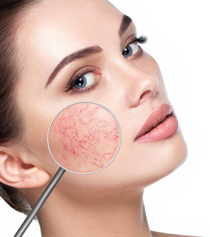 4 Quick Ways To Get Rid Of Broken Capillaries On The Face