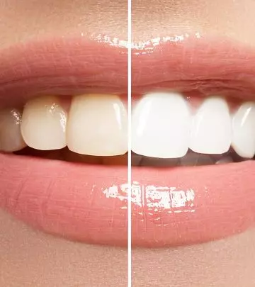 दांतों के पीलापन को हटाने के 16 घरेलू उपाय – Home Remedies for Teeth Whitening in Hindi