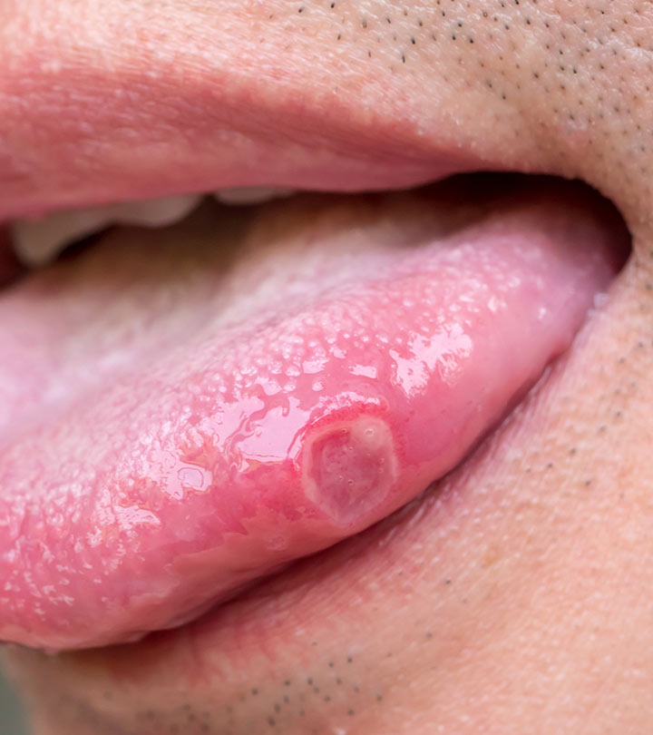 जीभ के छाले होने के कारण, लक्षण और घरेलू इलाज – Home Remedies for Tongue Ulcer in Hindi