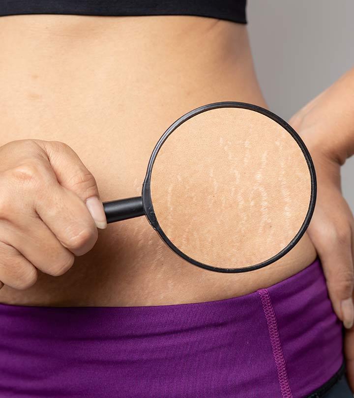 स्ट्रेच मार्क्स हटाने के उपाय – How To Remove Stretch Marks in Hindi