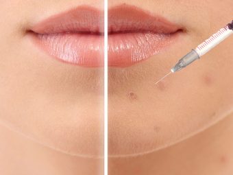 Cortisone Shots For Acne What You Need To Know About Them