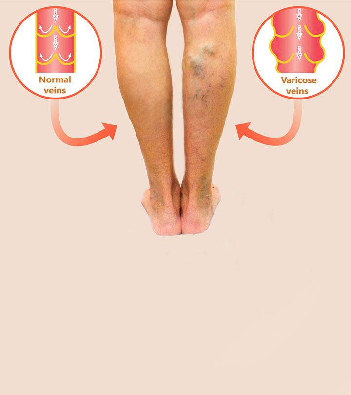 वैरिकोज वेन्स के कारण, लक्षण और इलाज – Varicose Veins Causes, Symptoms and Treatment in Hindi