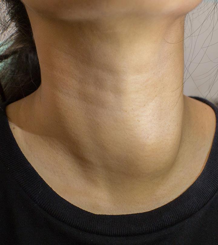 घेंघा के कारण, लक्षण और इलाज – Goiter Causes, Symptoms and Treatment in Hindi