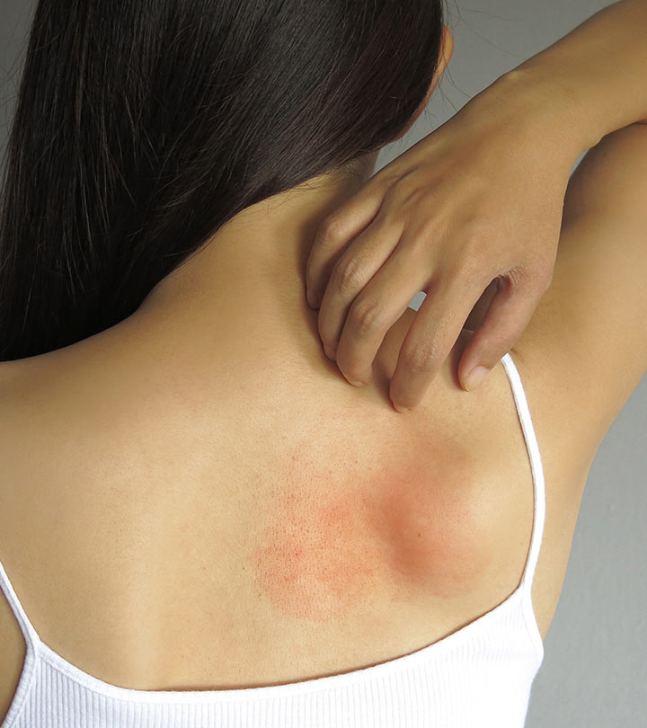 स्किन एलर्जी के कारण, लक्षण और घरेलू इलाज – Skin Allergy Symptoms and Home Remedies in Hindi