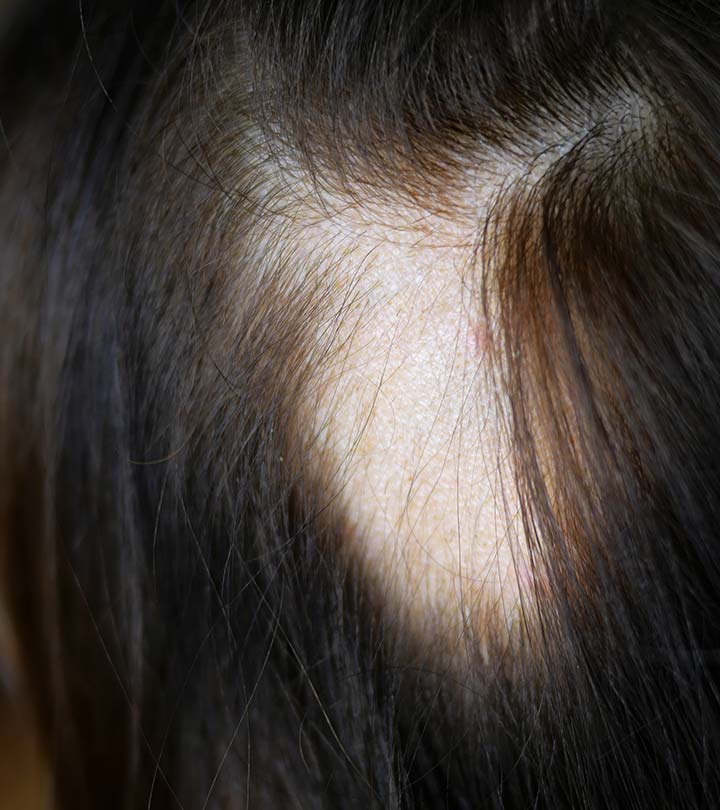 Athritis drug found to be 'miracle' cure for hair loss | The Citizen