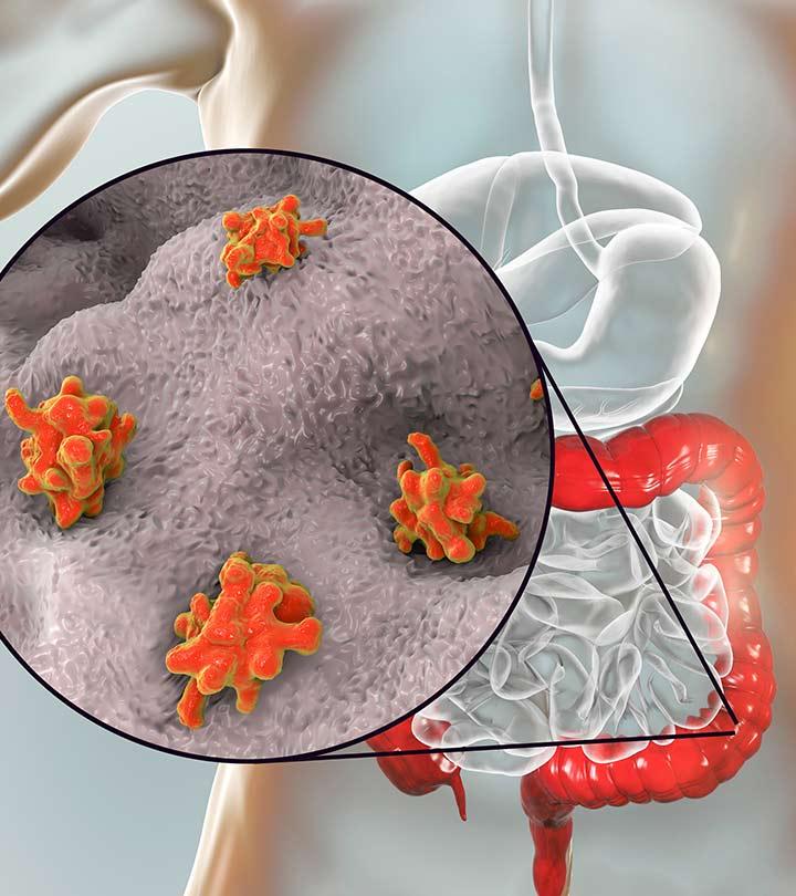 पेचिश के कारण, लक्षण और घरेलू उपाय – Dysentery Causes, Symptoms and Home Remedies in Hindi