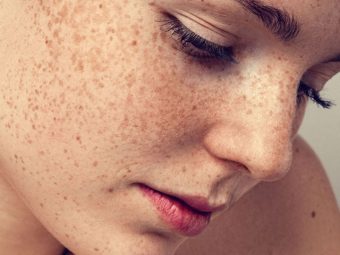 झाई (फ्रेकल्स) के कारण और घरेलू उपाय – Freckles Causes and Home Remedies in Hindi