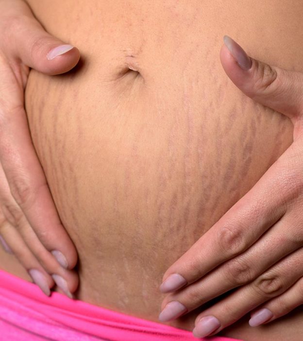 Red Stretch Marks: How To Treat Them