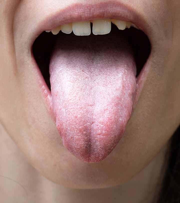 सफेद जीभ के कारण, लक्षण और घरेलू उपाय – White Tongue Causes, Symptoms and Home Remedies in Hindi