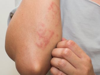 त्वचा पर चकत्ते के कारण, लक्षण और घरेलू उपाय – Skin Rashes Causes, Symptoms and Home Remedies in Hindi