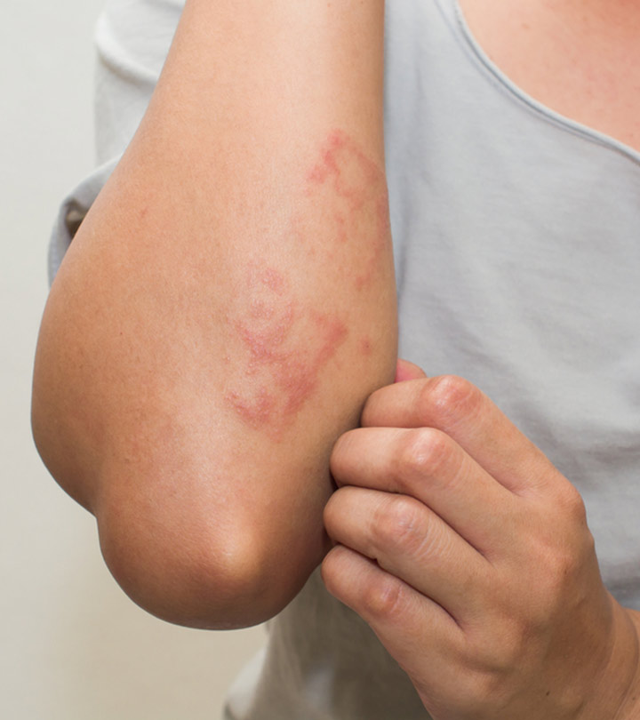 त्वचा पर चकत्ते के कारण, लक्षण और घरेलू उपाय – Skin Rashes Causes, Symptoms and Home Remedies in Hindi