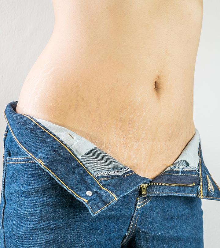 Stretch Marks In Teenagers – How They Develop And How To Treat Them