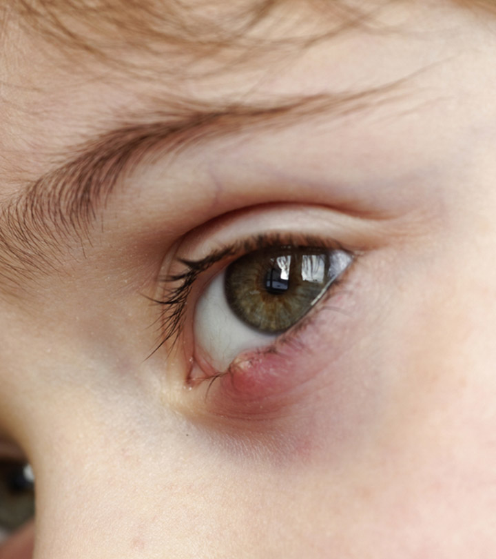 आंख में गुहेरी के कारण, लक्षण और घरेलू उपाय – Stye Causes, Symptoms and Home Remedies in Hindi