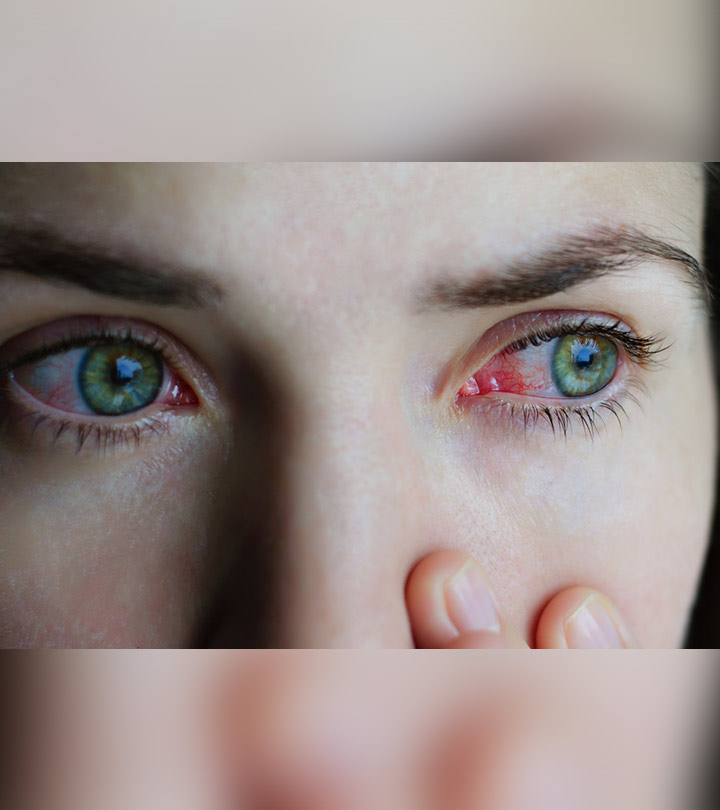 आँख आने के कारण, लक्षण और घरेलू इलाज – Home Remedies for Conjunctivitis (Pink Eye) in Hindi