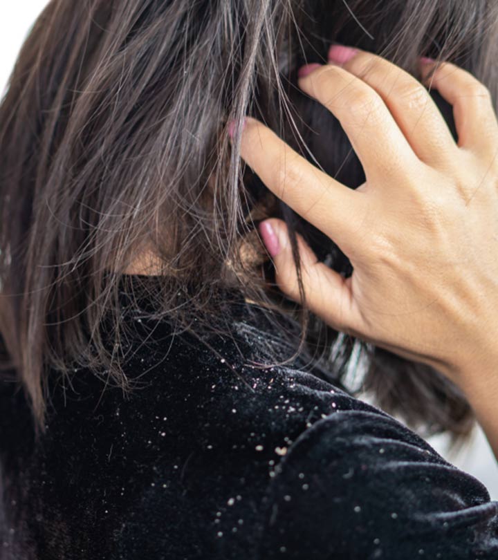 Is Dandruff Contagious? Causes, Treatments, & Myths About It