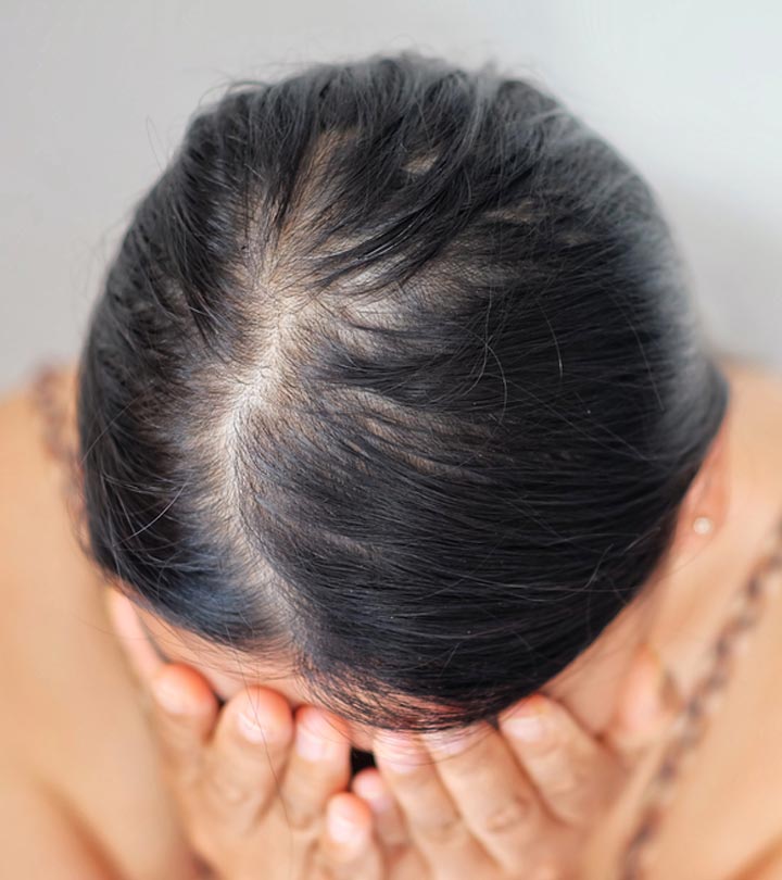 Female pattern hair loss | healthdirect