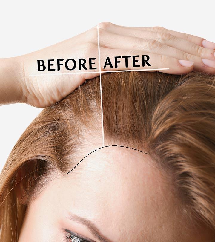 Women Showing Before And After Effect Of Hair Transplant Women Showing Before And After Effect Of Hair Transplant