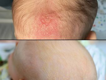 Cradle Cap Vs. Dry Scalp – What Is The Difference