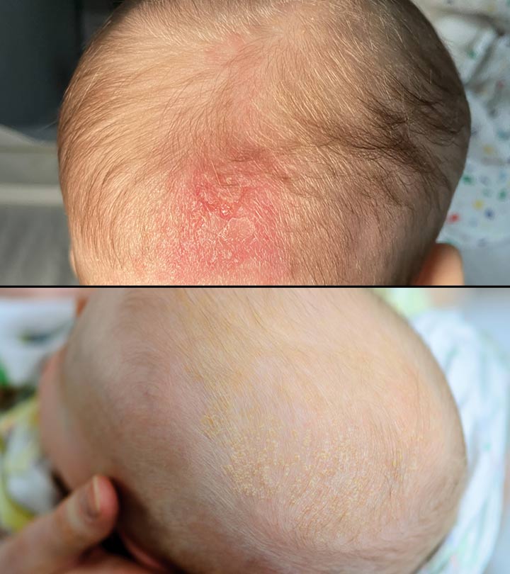 Cradle Cap Vs. Dry Scalp – What Is The Difference?