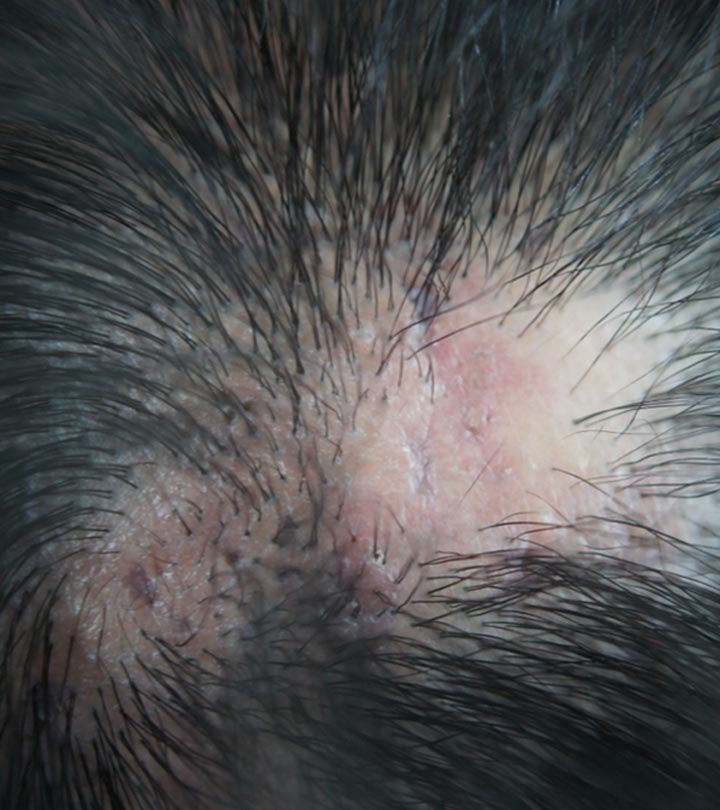 Scarring Alopecia – Types, Causes, Symptoms, And Treatments