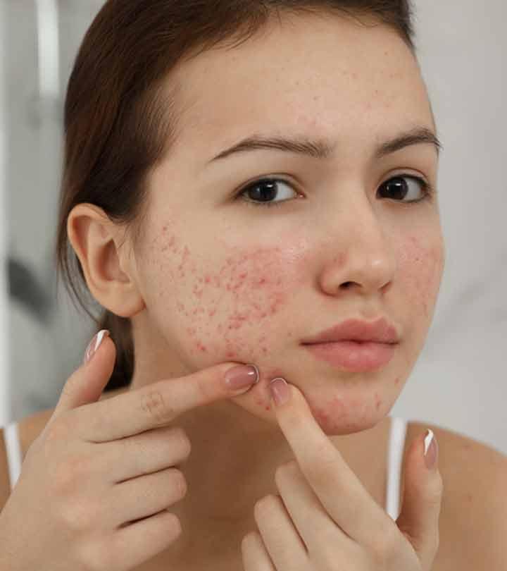 मुँहासे के लिए टी ट्री ऑयल के फायदे और उपयोग – Tea Tree Oil To Treat Acne in Hindi