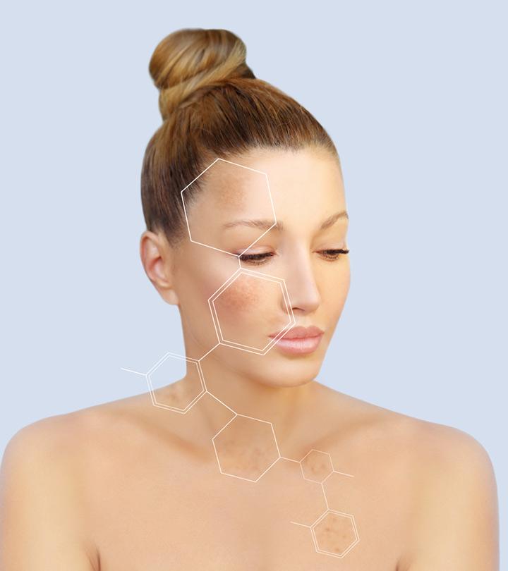 Melasma Causes Symptoms And Treatment Options