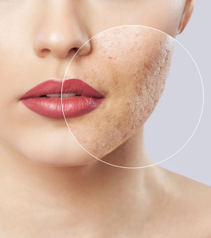 Types Of Acne Scars And How To Treat Them Naturally At Home