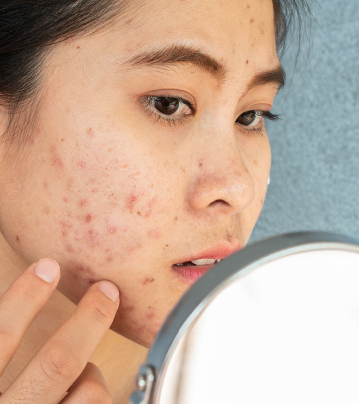 Fungal Acne: Symptoms, Causes, And Treatment Options