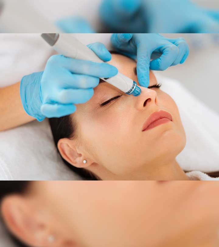 Laser Treatment For Acne Scars: Types, Procedure, And Cost
