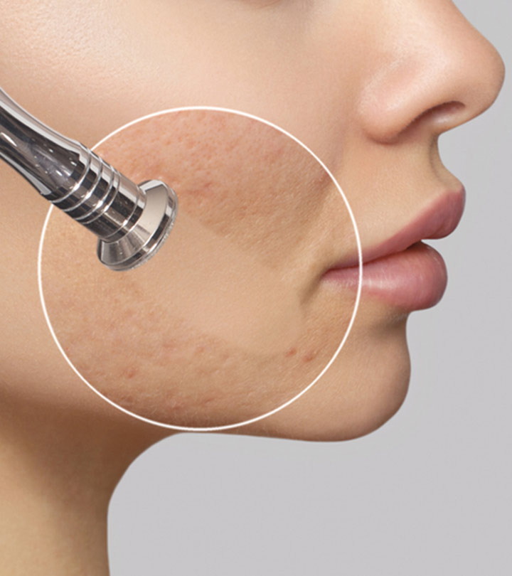 Microdermabrasion For Acne Scars: Benefits, Effects, & Cost