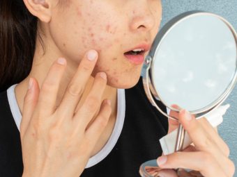 Nodular Acne Causes And How To Treat It
