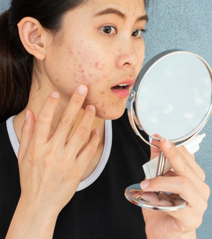 Nodular Acne: Causes, Treatment Options, & Home Remedies