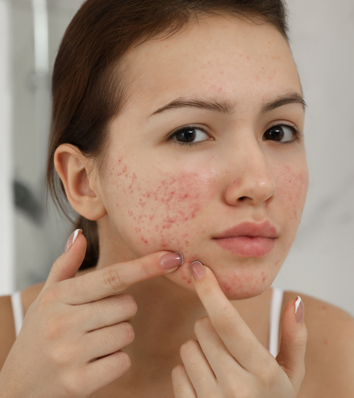 Vitamin D For Acne: Benefits, How To Use, And Side Effects