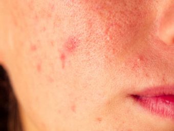 Acne Papules – Potential Causes & How To Get Rid Of Them