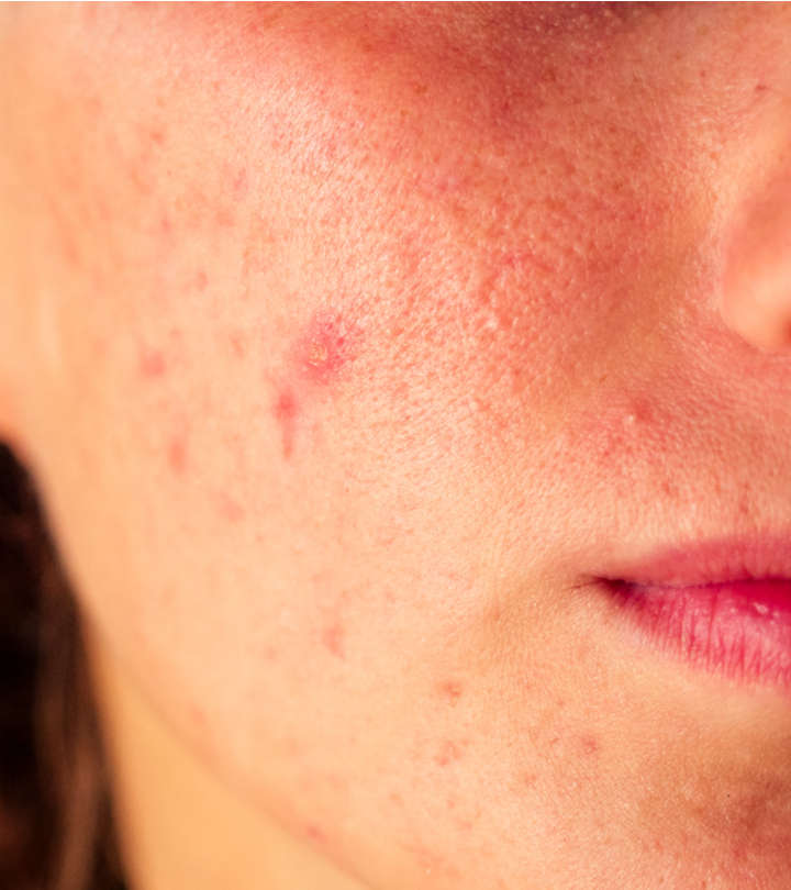 Acne Papules – Potential Causes & How To Get Rid Of Them
