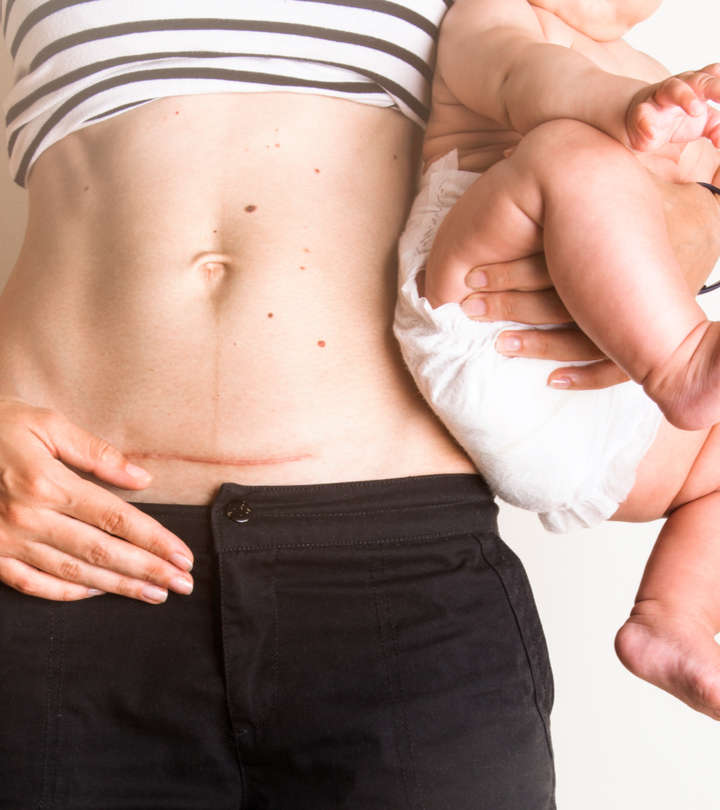 C-section Scars: Types, Healing Stages, And Side Effects