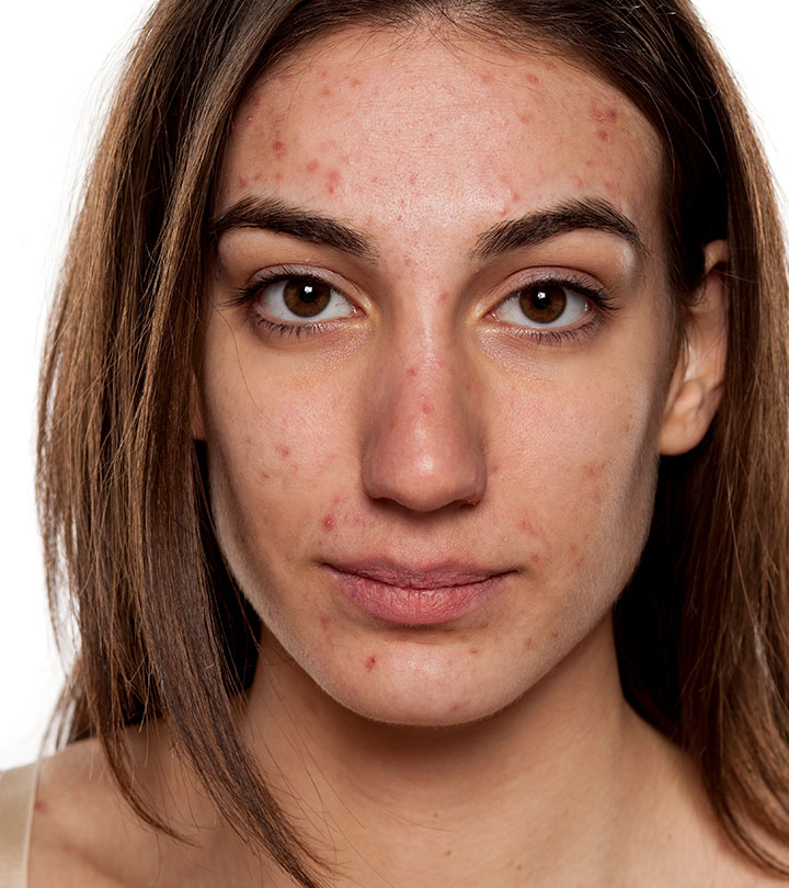 When Does Acne Stop? Its Life Cycle & Treatment Options