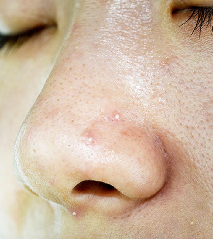 Whiteheads On Nose: Causes, Treatments, And Prevention