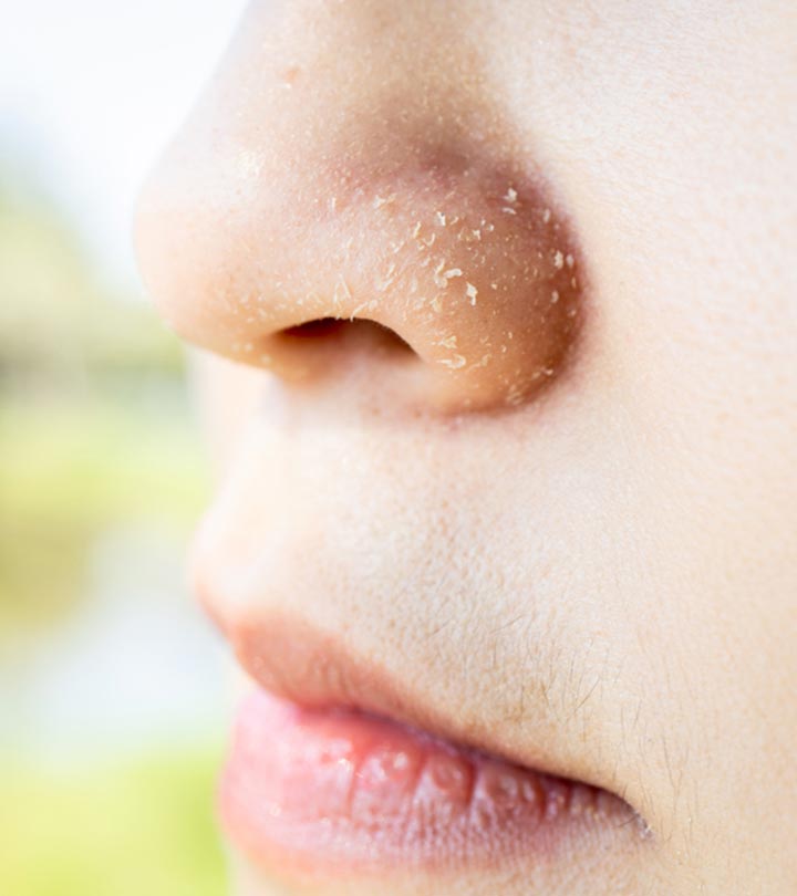 10 Remedies To Heal Dry Skin Around The Nose & Prevention Tips
